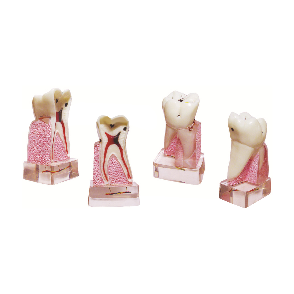Dental Pathological Model, 4x  - Medical Lab Supplies recension och pris